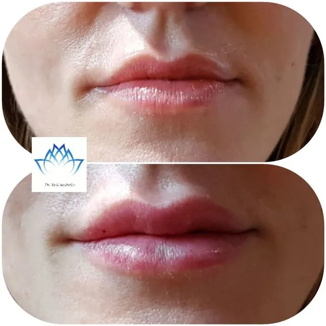 Before and after aesthetic treatment result 4 Dr Yash Aesthetics Colchester