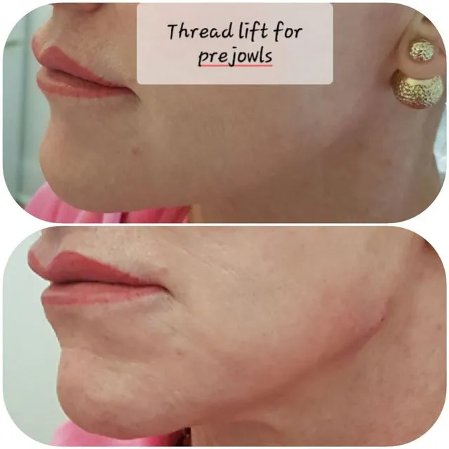 Before and after aesthetic treatment result 5 Dr Yash Aesthetics Colchester