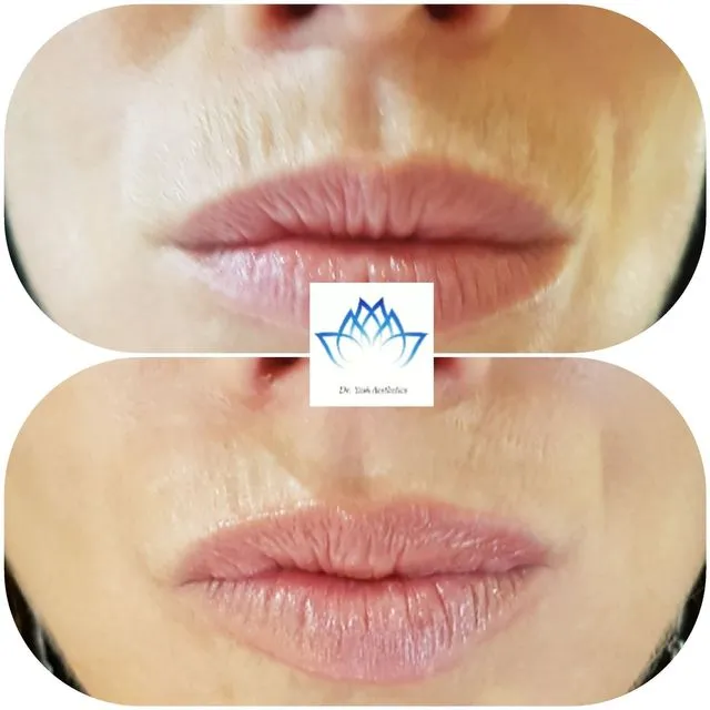 Before and after aesthetic treatment result 6 Dr Yash Aesthetics Colchester