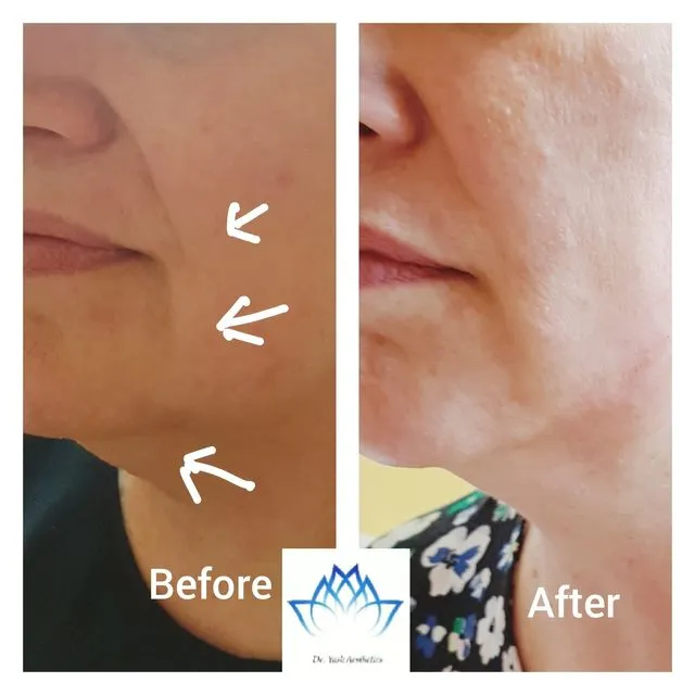 Before and after aesthetic treatment result 8 Dr Yash Aesthetics Colchester