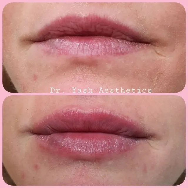 Before and after aesthetic treatment result 10 Dr Yash Aesthetics Colchester