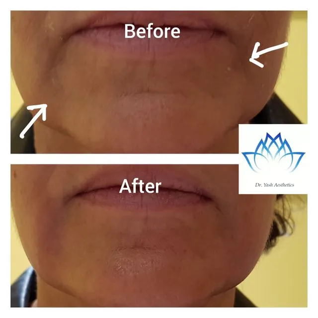 Before and after aesthetic treatment result 11 Dr Yash Aesthetics Colchester