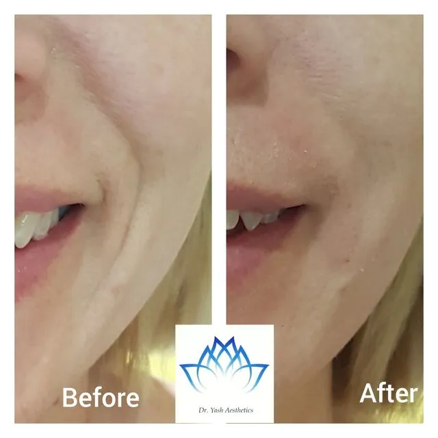 Before and after aesthetic treatment result 12 Dr Yash Aesthetics Colchester