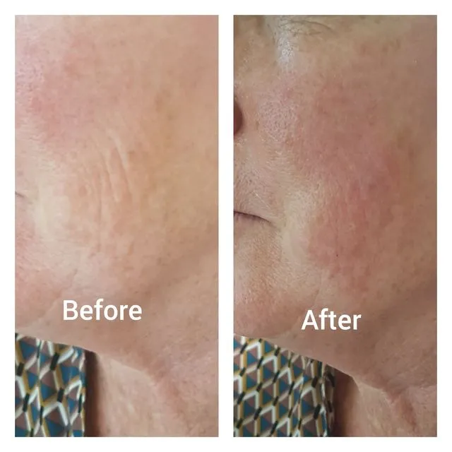 Before and after aesthetic treatment result 14 Dr Yash Aesthetics Colchester
