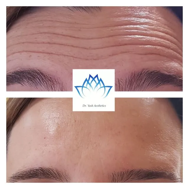Before and after aesthetic treatment result 15 Dr Yash Aesthetics Colchester